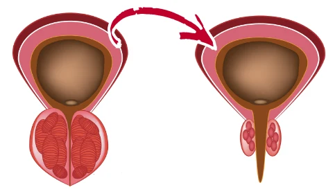 prostate transformation